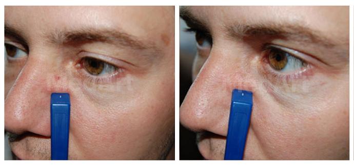 фото до і після видалення судинної зірочки на обличчі діодним лазером VariMed
