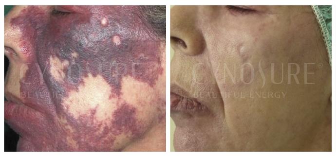 Видалення винної плями на обличчі судинним лазером Cynergy фото до та після