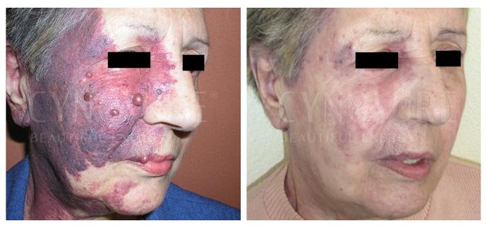 Видалення гемангіом на обличчі судинним лазером Cynergy фото до та після