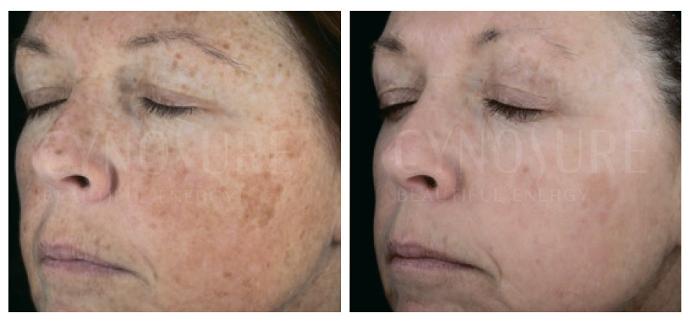 Фотопошкоджена шкіра, до та після процедур Elite iQ