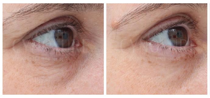 RF ліфтинг навколо очей апаратом TempSure Envi, фото до та після