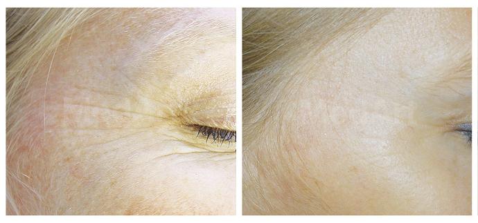 Зморшки навколо очей, шліфування фракційним лазером MedArt FRx фото до та після процедури